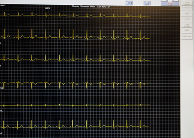 Holter-monitor-and-long-term-arrhythmia-surveillance-techniques