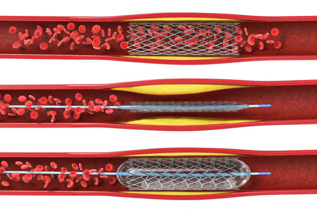 Riverside-Coronary-Interventions